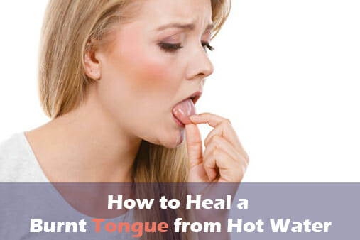 How To Heal A Burnt Tongue From Hot Water: 13 Remedies - How To Heal A Burnt Tongue From Hot Tea